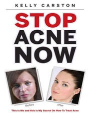 Stop Acne Now: This Is Me and This Is My Secret On How to Treat Acne