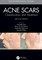 Acne Scars