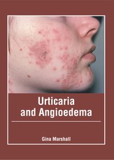 Urticaria and Angioedema