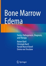 Bone Marrow Edema