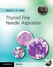 Thyroid Fine Needle Aspiration