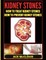 Kidney Stones