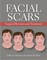 Facial Scars