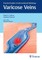 Varicose Veins