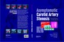Asymptomatic Carotid Artery Stenosis