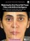 Mastering the Art of Facial Soft Tissue Fillers with Artificial Intelligence