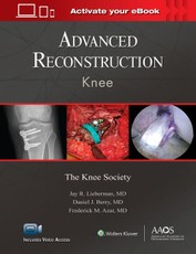 Advanced Reconstruction Knee